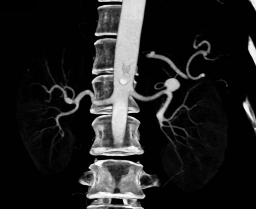 Left Renal Artery Aneurysm - CTisus CT Scan