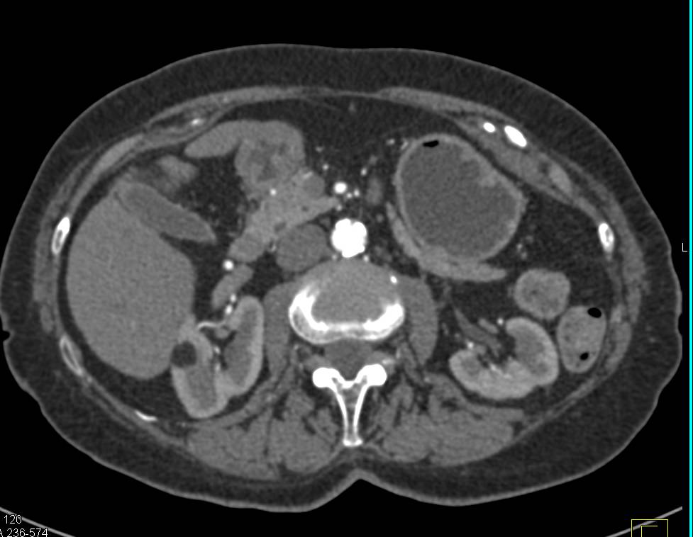 Incidental Angiomyolipoma Right Kidney and Fibromuscular Dysplasia (FMD) Right Renal Artery - CTisus CT Scan