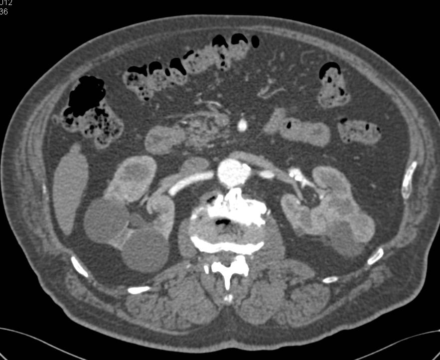 Multiple Simple and Complex Renal Cysts - CTisus CT Scan