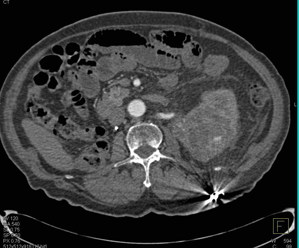 Left Renal Cell Carcinoma in Patient with Prior Right Nephrectomy for Renal Carcinoma - CTisus CT Scan