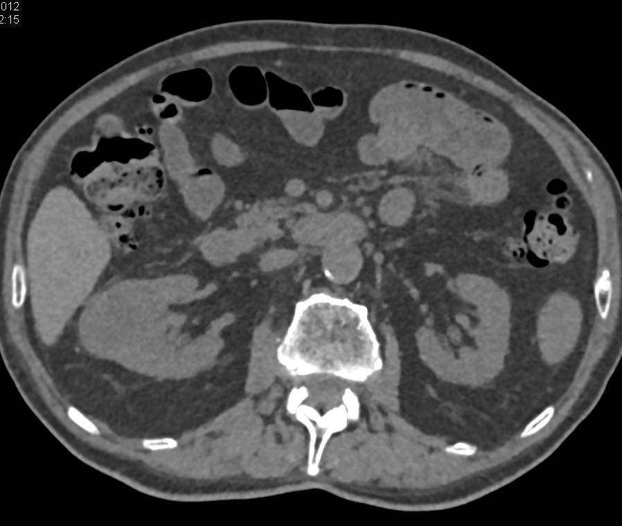 Clear Cell Renal Cell Carcinoma with Neovascularity - CTisus CT Scan