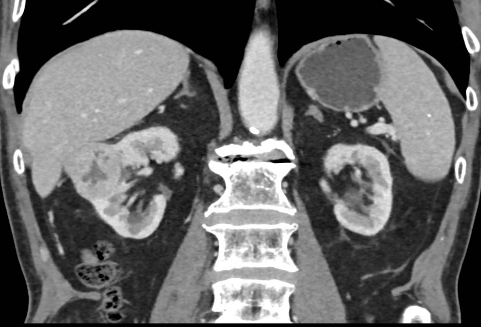 Central Scar in a Clear Cell Renal Cell Carcinoma - CTisus CT Scan