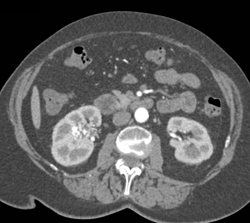 Arteriovenous (AV) Fistulae in the Right Renal Pelvis - CTisus CT Scan