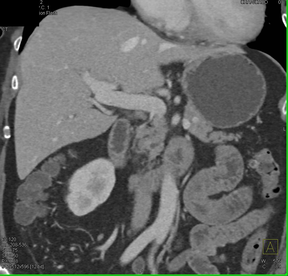 Arteriovenous (AV) Fistulae in the Right Renal Pelvis - CTisus CT Scan