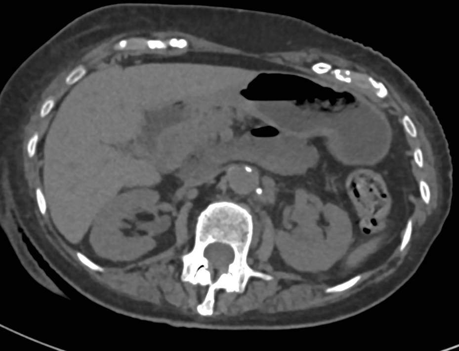 Transitional Cell Carcinoma Left Kidney - CTisus CT Scan