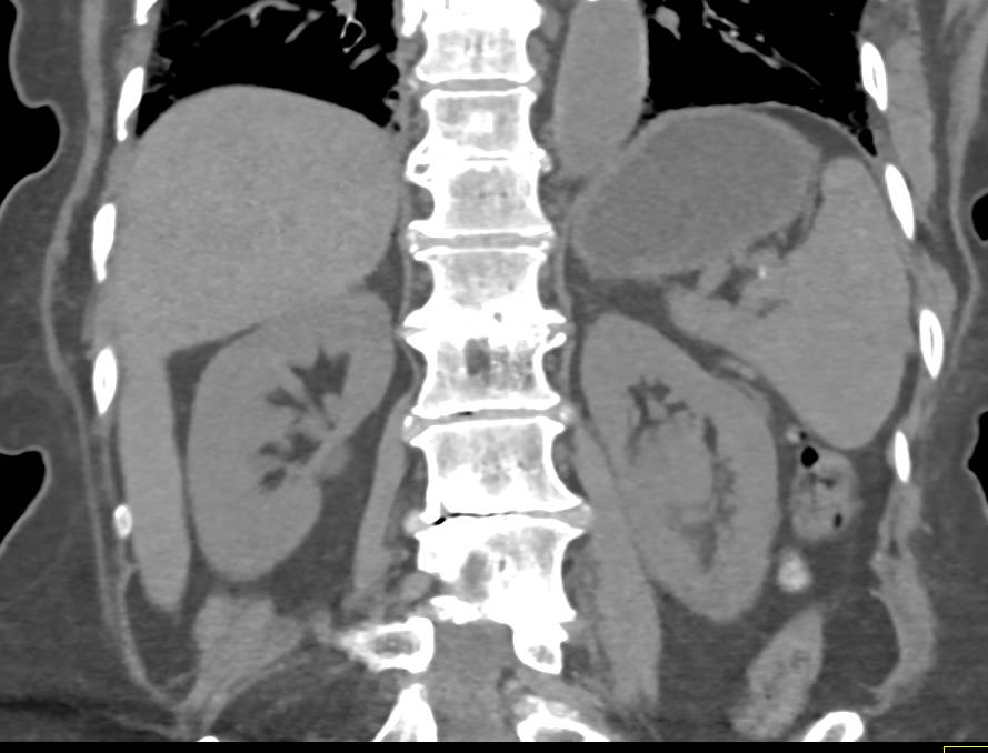 Transitional Cell Cancer (TCC) Left Kidney Also Involves the Left Ureter - CTisus CT Scan