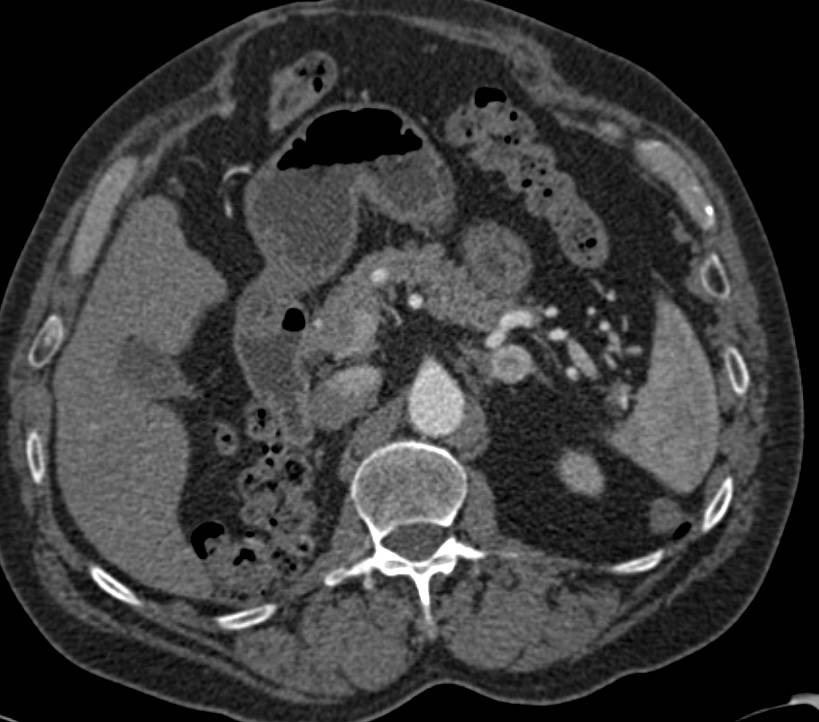 Recurrent Renal Cell Carcinoma with Metastases to the Small Bowel and Mesentery - CTisus CT Scan