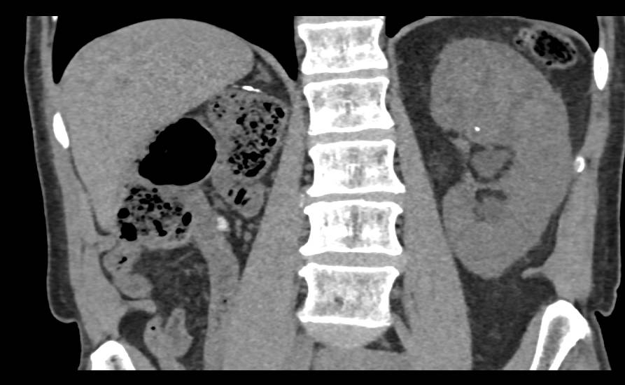 Multiple Renal Calculi in a Solitary Kidney - CTisus CT Scan