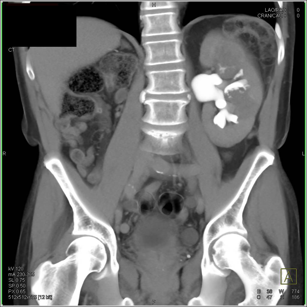 Transitional Cell Cancer (TCC) Left Kidney and Right Side of Bladder - CTisus CT Scan