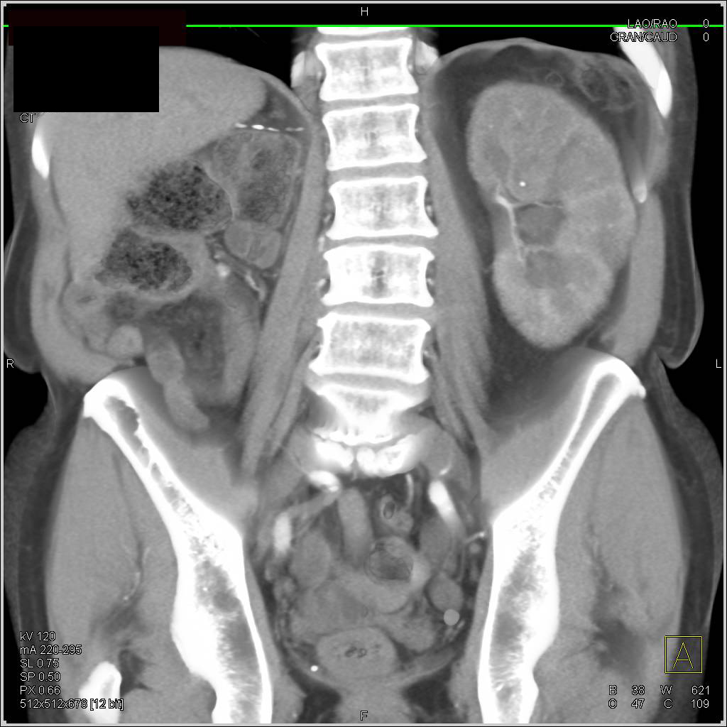 Multiple Renal Calculi in a Solitary Kidney - CTisus CT Scan