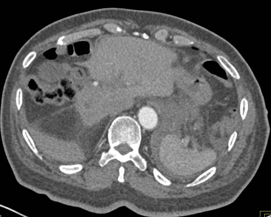 Perirenal Bleed Left Kidney - CTisus CT Scan