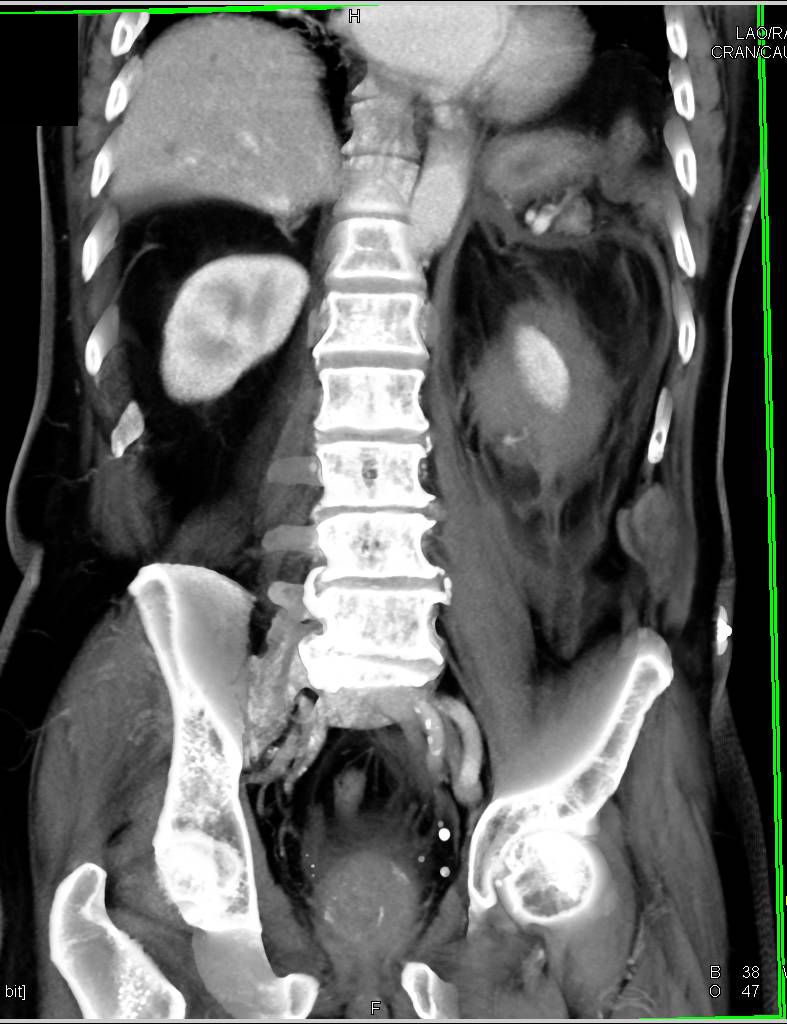 Active Perirenal Bleed Left Kidney - CTisus CT Scan