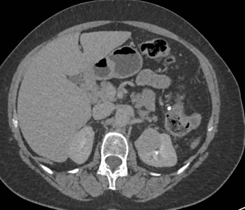 Incidental Papillary Renal Cell Carcinoma Left Kidney - CTisus CT Scan