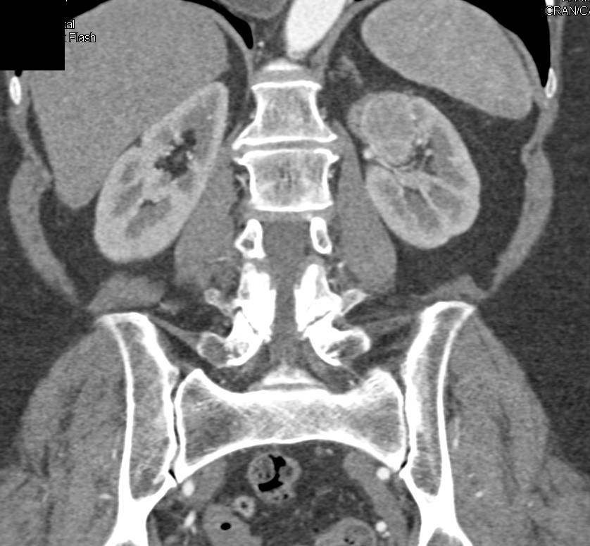 Incidental Papillary Renal Cell Carcinoma Left Kidney - CTisus CT Scan