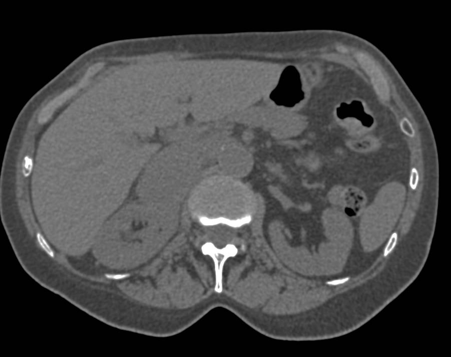 Right Renal Artery Stenosis - CTisus CT Scan