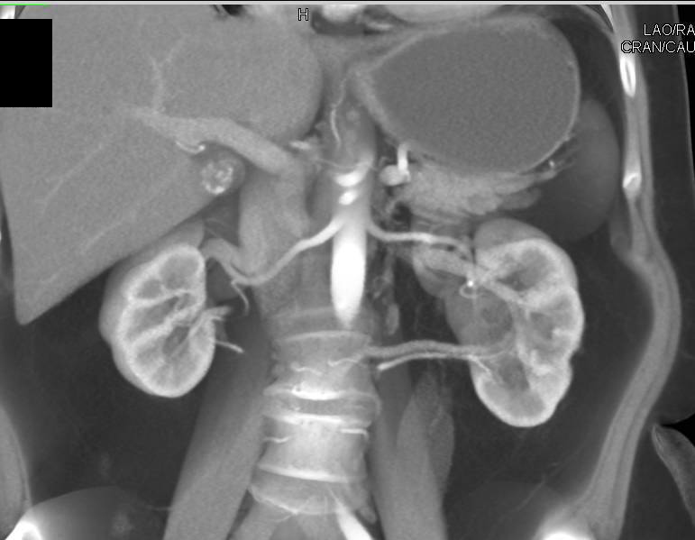 Duplicated and Obstructed Left Collecting System due to Ureteral Calculi - CTisus CT Scan