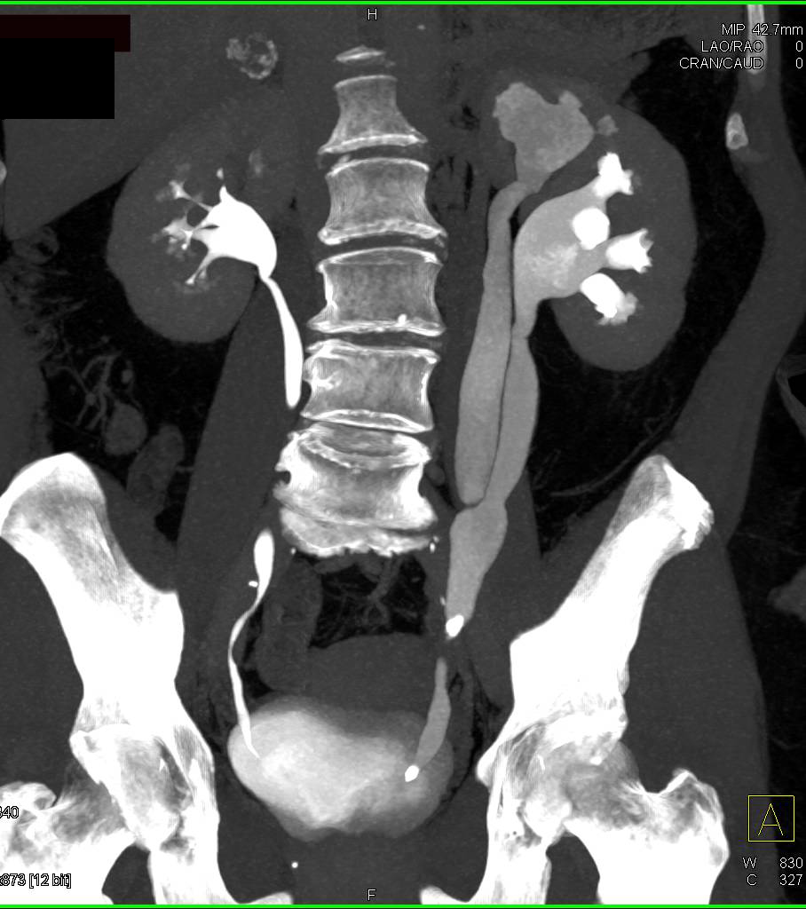 Duplicated and Obstructed Left Collecting System due to Ureteral Calculi with Multiple Renderings in 3D - CTisus CT Scan