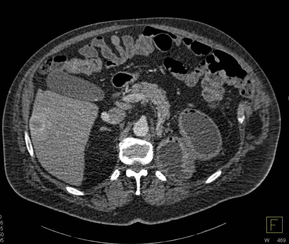 Left Nephrectomy for Renal Cell Carcinoma (RCC) with Metastases to Liver and Small Bowel - CTisus CT Scan