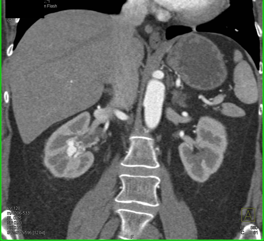 Arteriovenous (AV) Fistulae in the Right Renal Pelvis - CTisus CT Scan