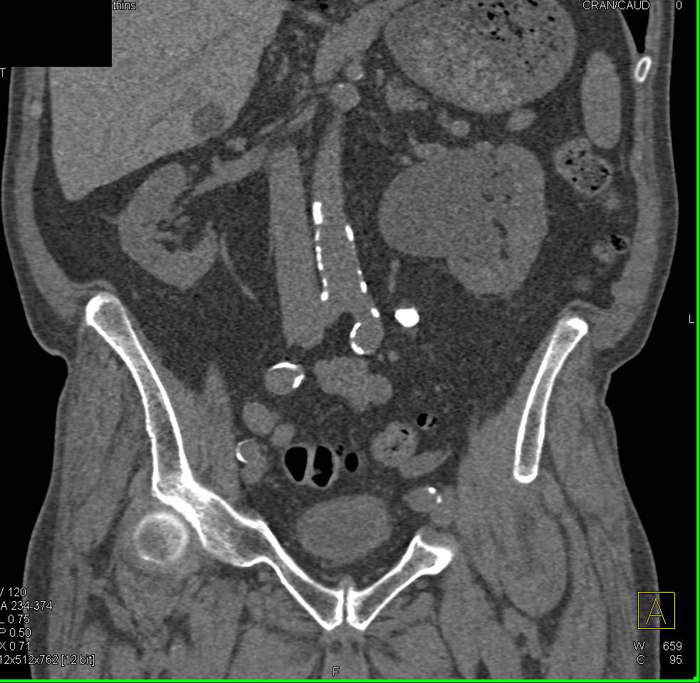 Stone Obstructs the Left Ureter - CTisus CT Scan