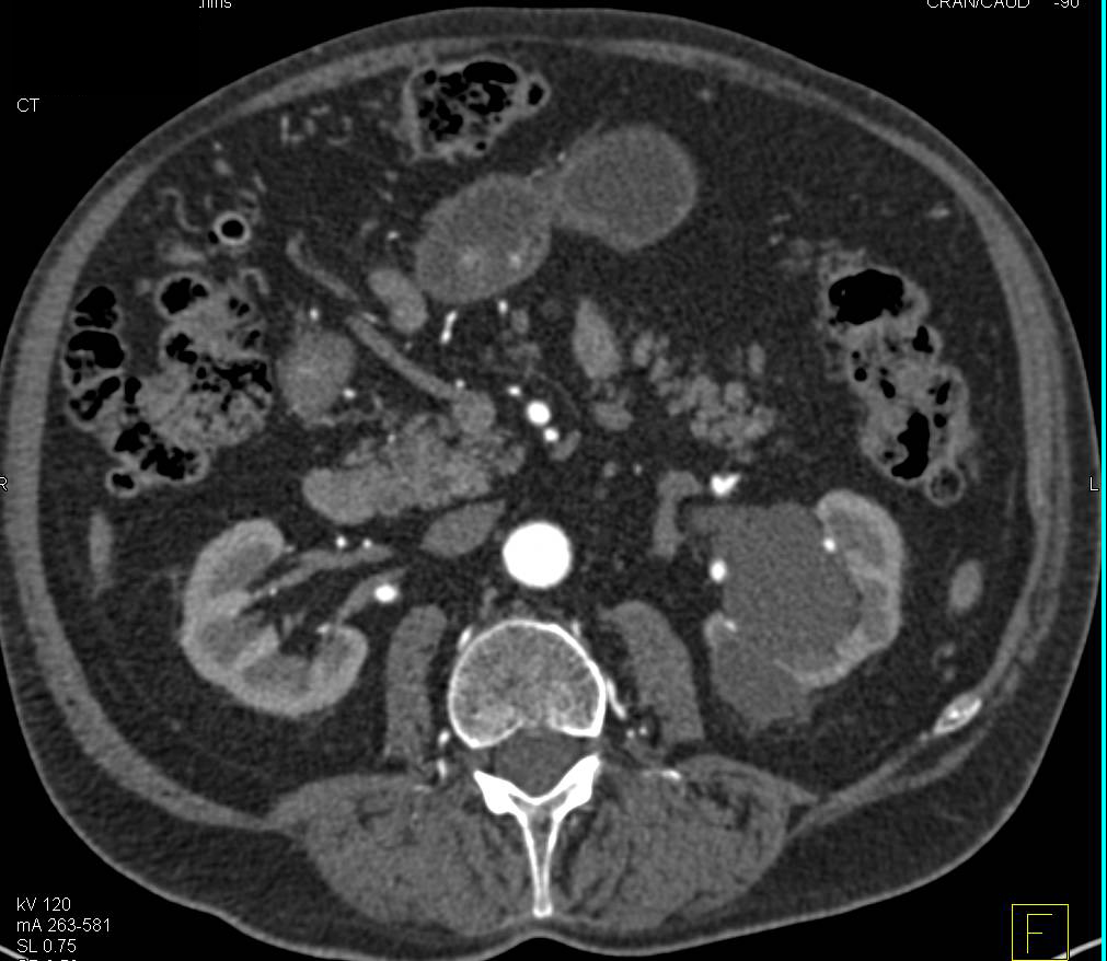 Stone Obstructs the Left Ureter and Pelvis - CTisus CT Scan