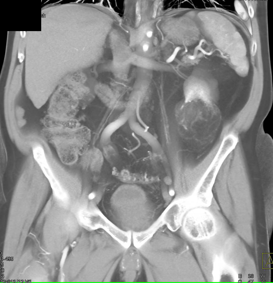 Renal Angiomyolipoma (AML) in Patient with Serous Cystadenoma - CTisus CT Scan