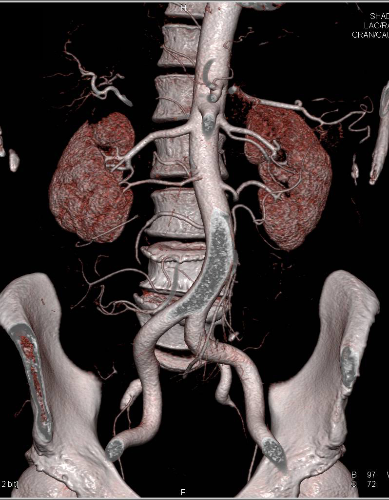 Prehilar Branching Upper Pole Left Renal Artery - CTisus CT Scan