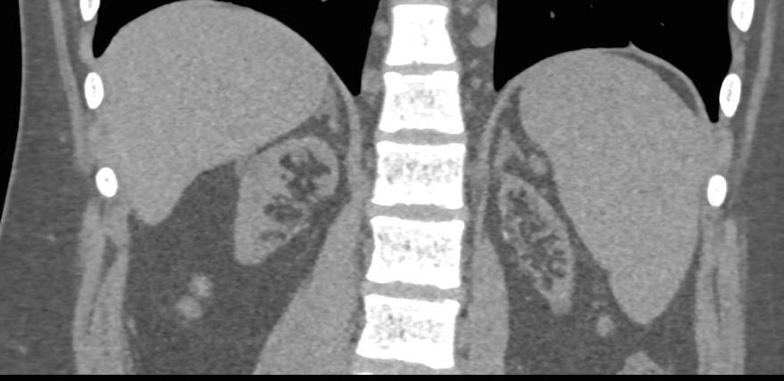 ESRD (end stage renal disease) with Numerous Cysts - CTisus CT Scan