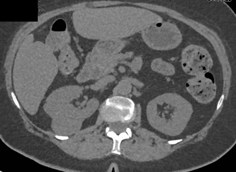 Papillary Right Renal Cell Carcinoma - CTisus CT Scan