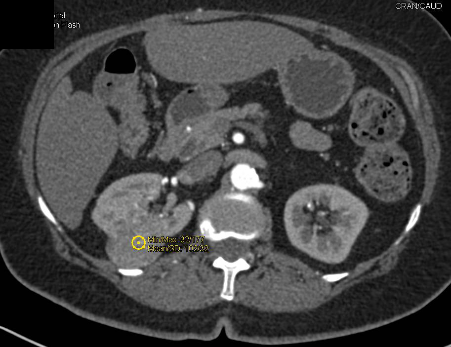 Papillary Right Renal Cell Carcinoma - CTisus CT Scan