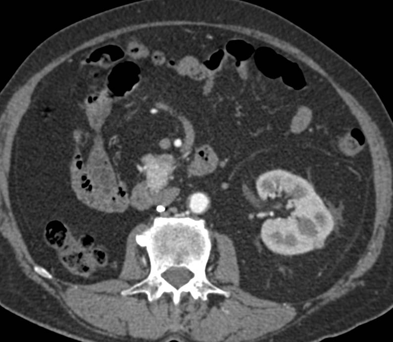 Recurrent Renal Cell Carcinoma with Metastases to the Pancreas - CTisus CT Scan