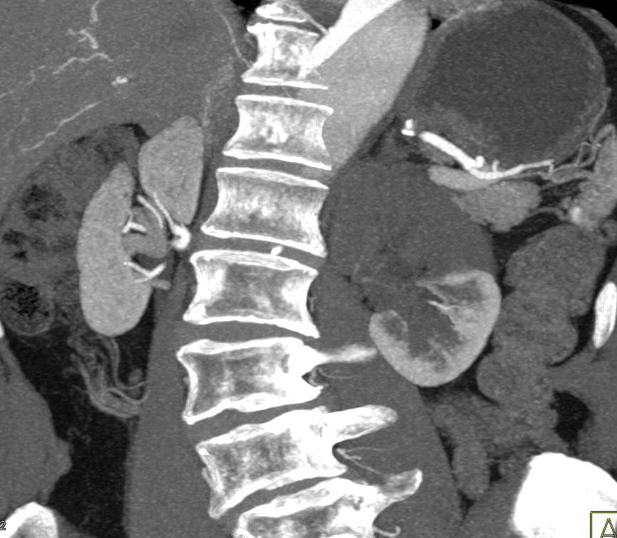 Upper Pole Left Renal Artery Not Supplied From true Lumen with Decreased Renal Flow - CTisus CT Scan