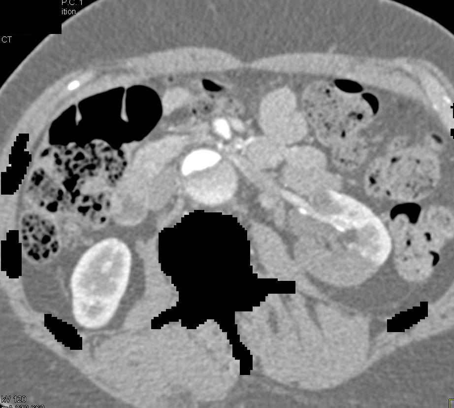 Upper Pole Left Renal Artery Not Supplied From true Lumen with Decreased Renal Flow Early and Perfused Late - CTisus CT Scan