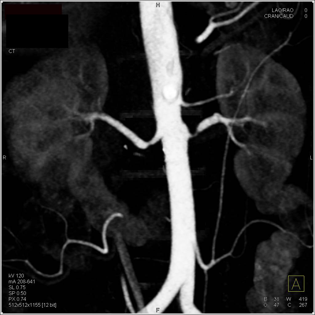 Renal Artery Stenosis Bilaterally but Worst in Left Renal Artery - CTisus CT Scan