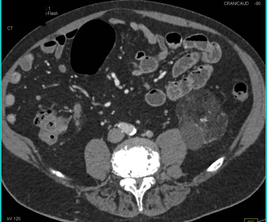 Left Renal Angiomyolipoma - CTisus CT Scan