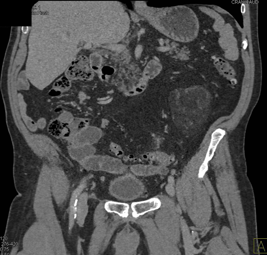 Left Renal Angiomyolipoma - CTisus CT Scan