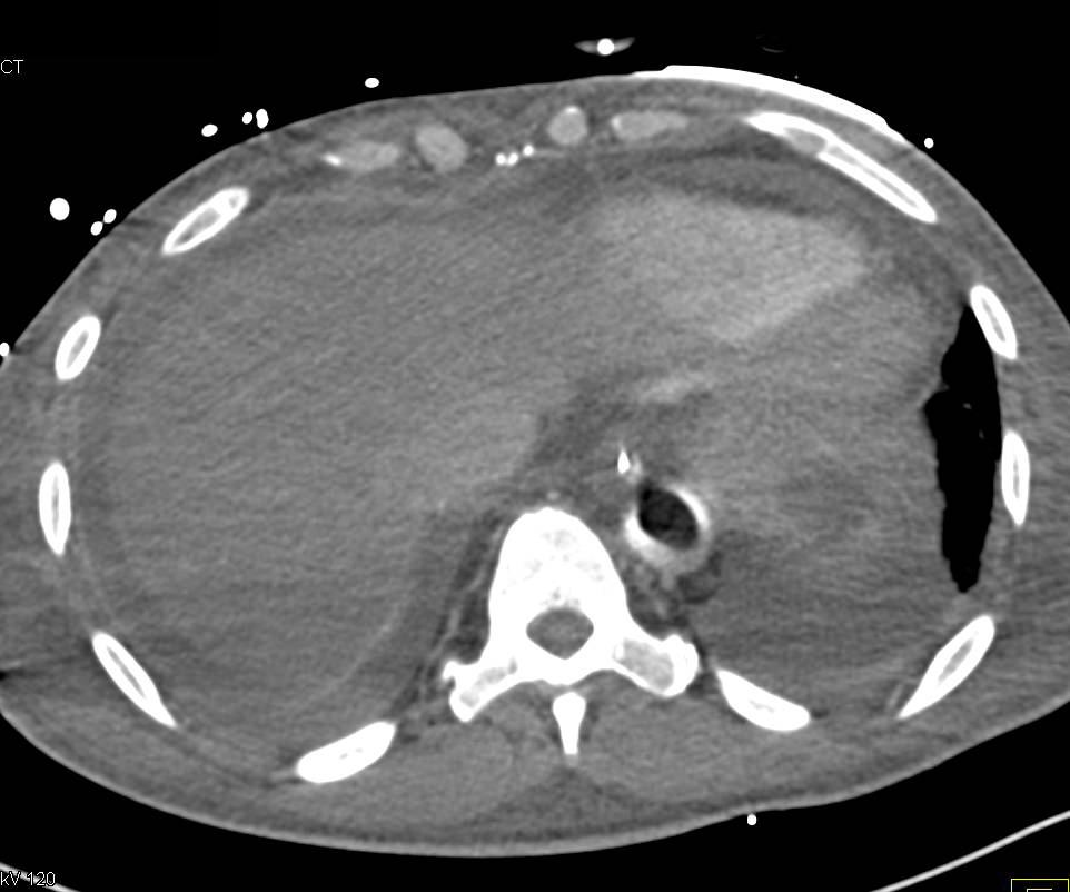 Intra-arterial Pump with Poor Perfusion of the Kidneys - CTisus CT Scan