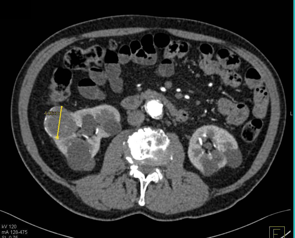 Cystic Renal Cell Carcinoma - CTisus CT Scan