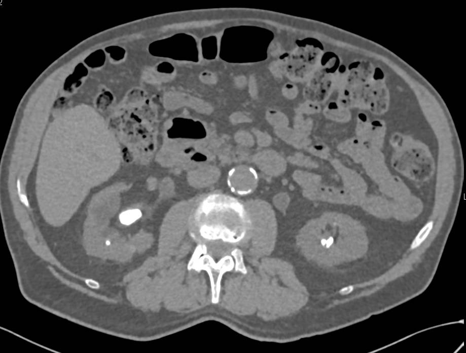 Multifocal Transitional Cell Carcinoma - CTisus CT Scan