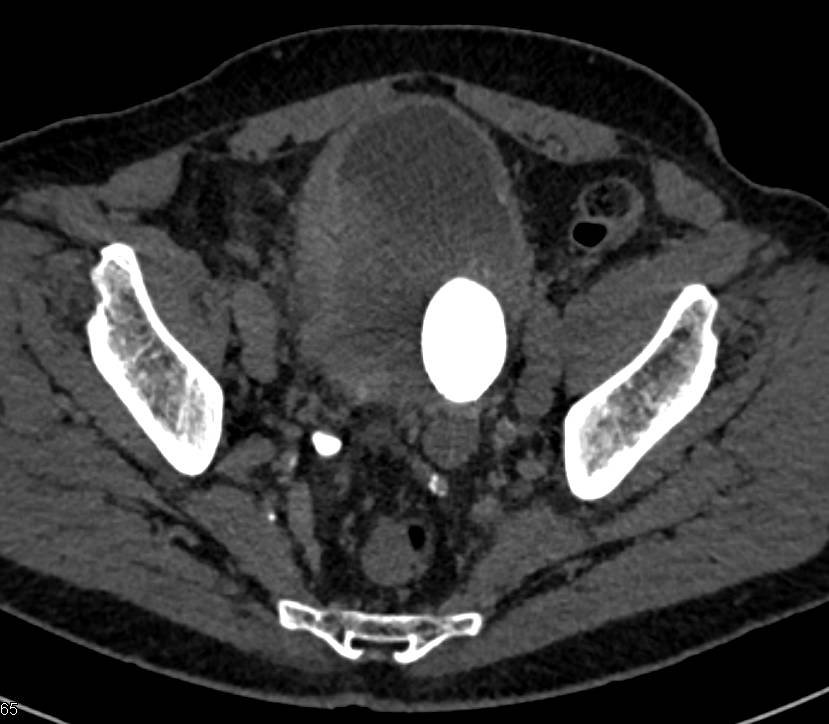 Multifocal Transitional Cell Carcinoma as Well as Left Bladder Calculus - CTisus CT Scan