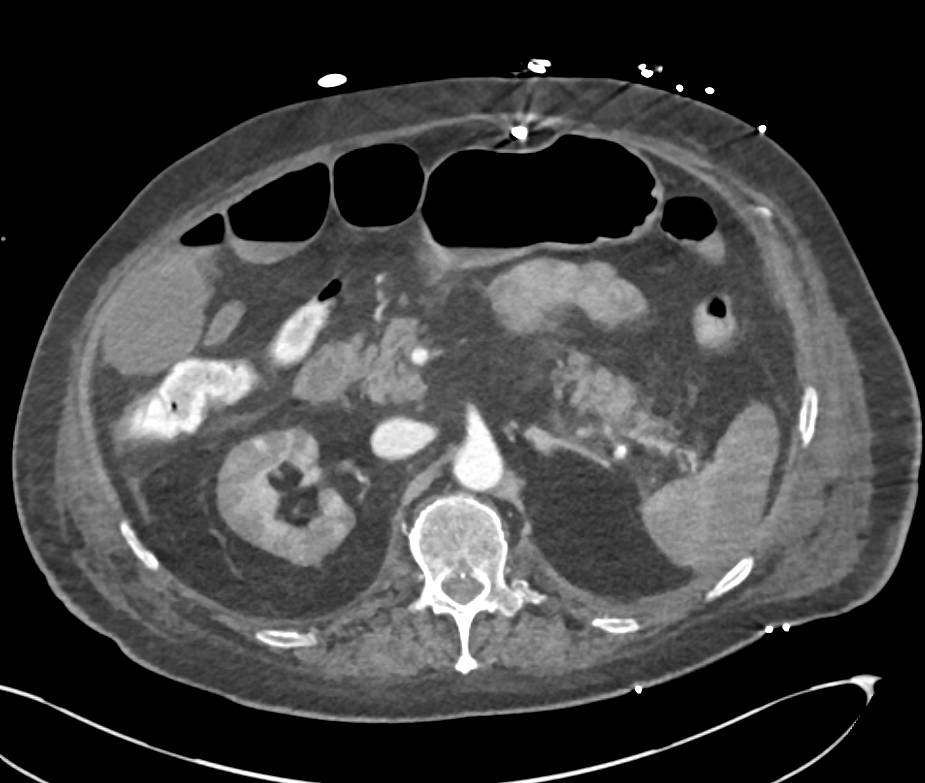 Perfusion Changes Kidney and Spleen in Hypotensive Patient - CTisus CT Scan