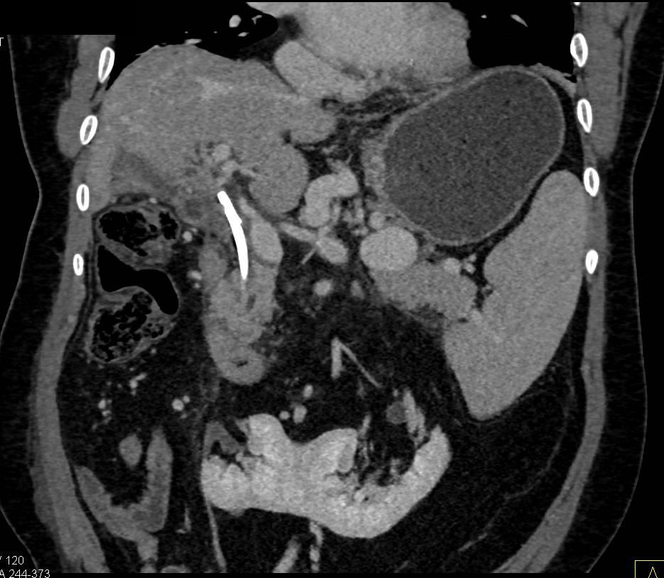 Horseshoe Kidneys - CTisus CT Scan