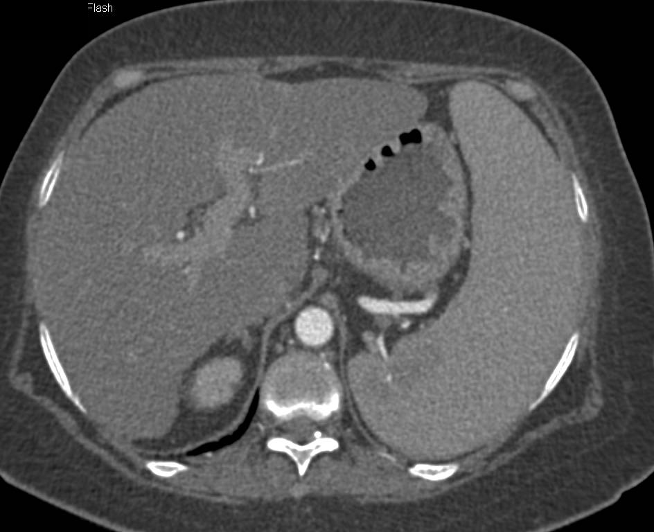 Lymphoma with Renal Involvement - CTisus CT Scan