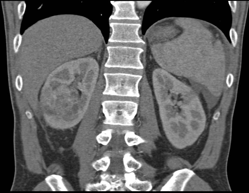 Papillary Right Renal Cell Carcinoma - CTisus CT Scan