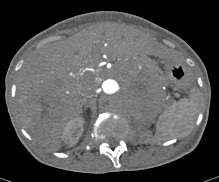 Metastatic Renal Cell Carcinoma to the Adrenal Gland, Liver and Adenopathy - CTisus CT Scan