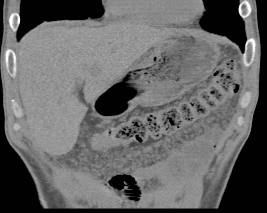 Renal Cell Carcinoma with Carcinomatosis - CTisus CT Scan