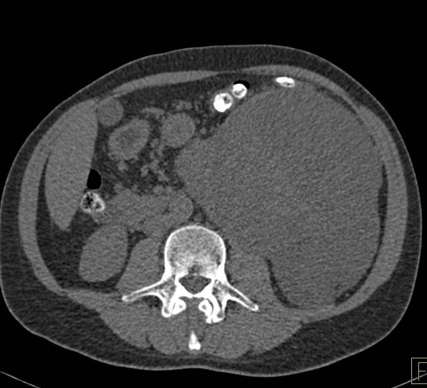 Retroperitoneal Sarcoma - CTisus CT Scan