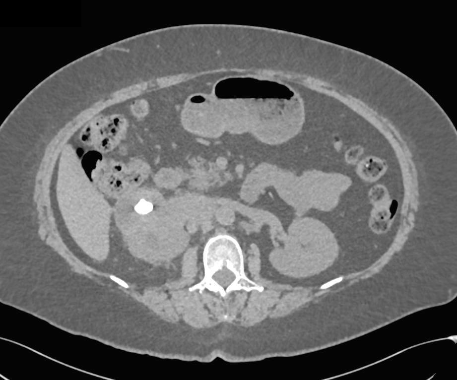 Transitional Cell Carcinoma Right Kidney Simulates Xanthogranulomatous Pyelonephritis (XGP) - CTisus CT Scan