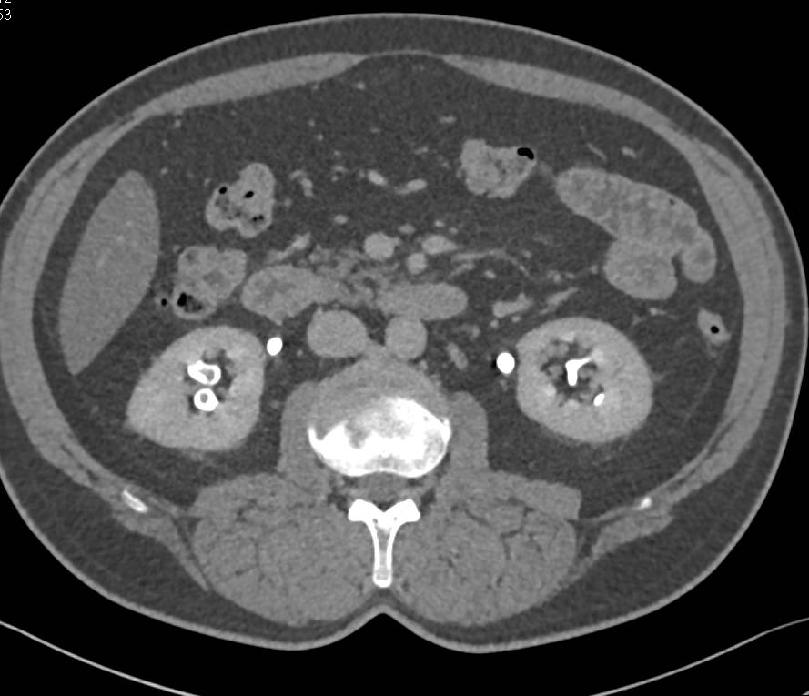 Papillary Necrosis Best Seen on 3D CT - Kidney Case Studies - CTisus CT