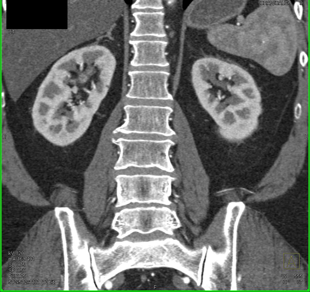 Papillary Necrosis Best Seen on 3D CT in Excretory Phase Imaging - CTisus CT Scan